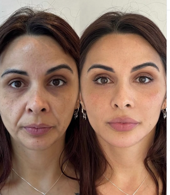 Full Face with hyaluronic acid — complete transformation.  